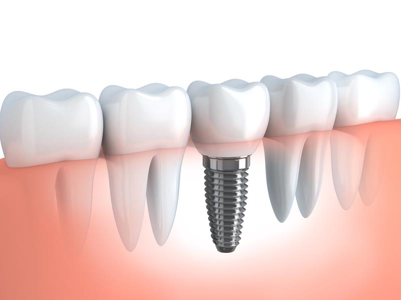 Dental Implants  Clinton, MA 